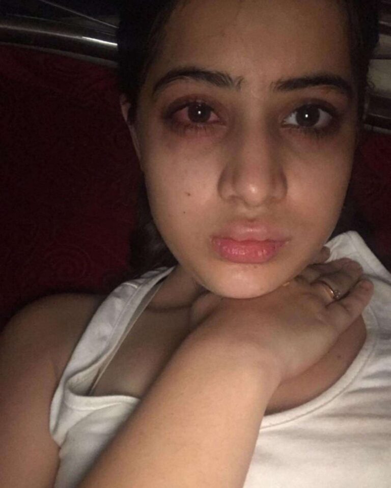 Urfi Javed shared his painful lip filler journey, your heart will be shocked to see the pictures